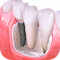 Implantologie dentară
